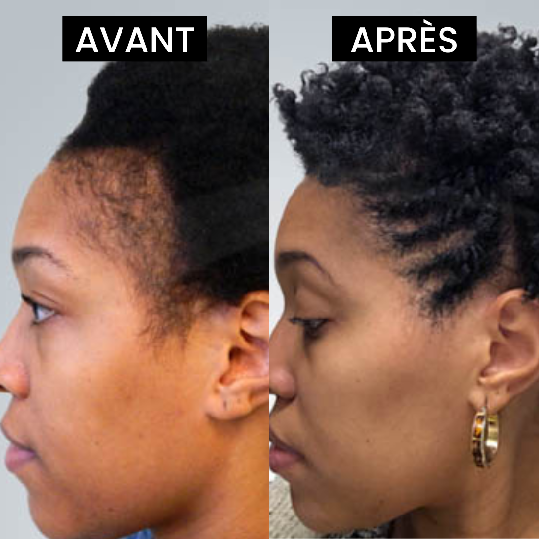 Huile anti chute de cheveux pour cheveux et barbe